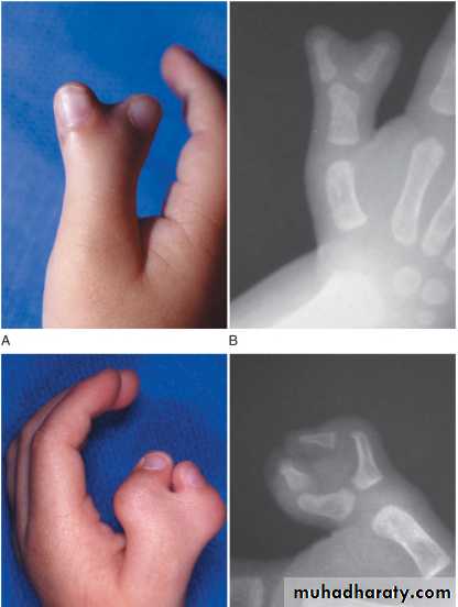 Upper limbs orthopedic