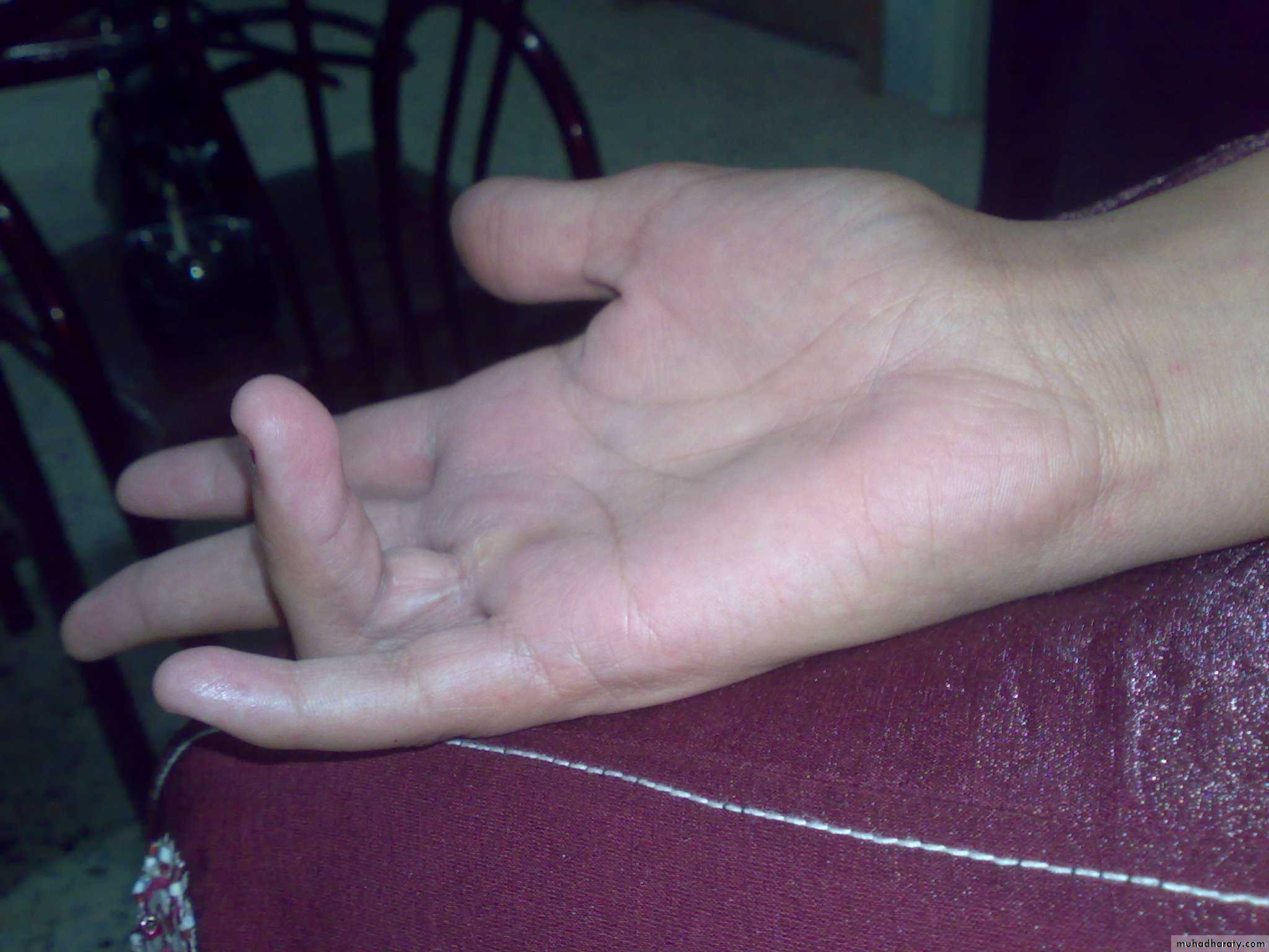 Upper limbs orthopedic