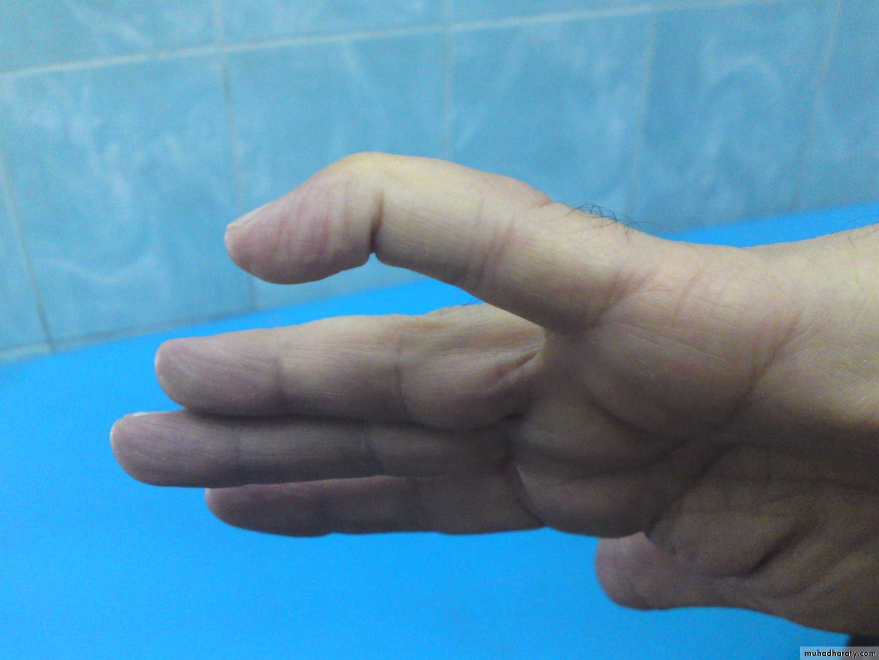 Upper limbs orthopedic