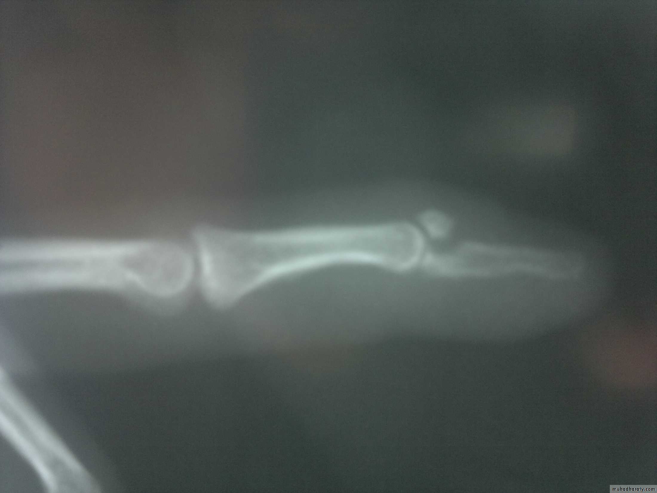 Upper limbs orthopedic