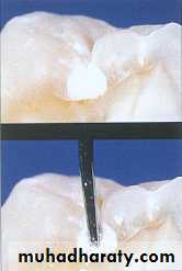 Diagnosis of caries