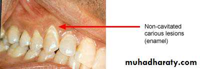 Diagnosis of caries