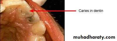 Diagnosis of caries