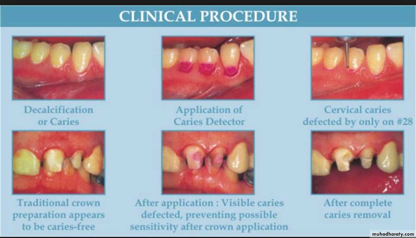 Diagnosis of caries