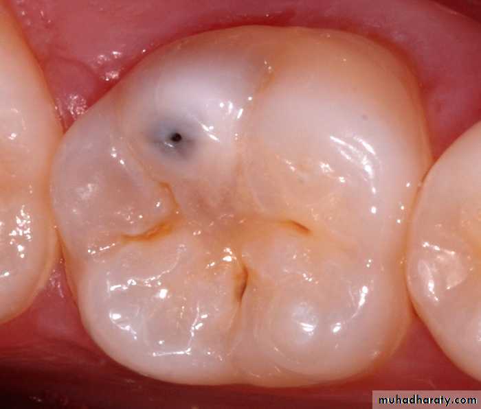Diagnosis of caries