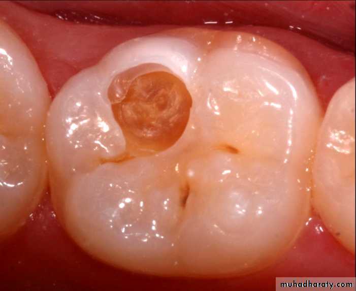 Diagnosis of caries