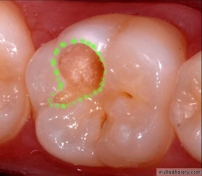 Diagnosis of caries