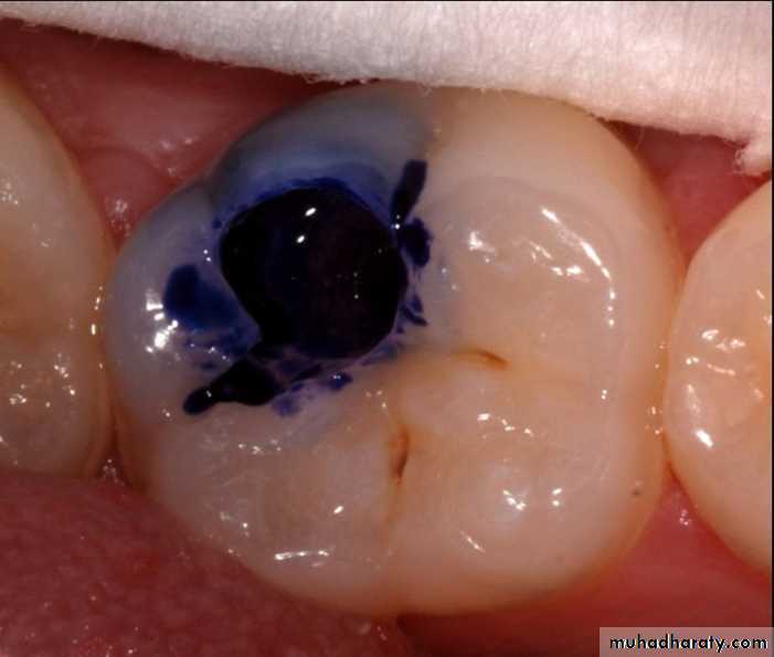 Diagnosis of caries