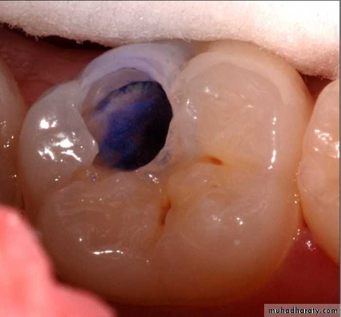 Diagnosis of caries