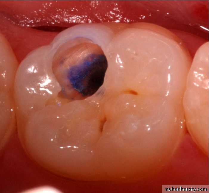 Diagnosis of caries