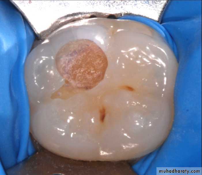 Diagnosis of caries