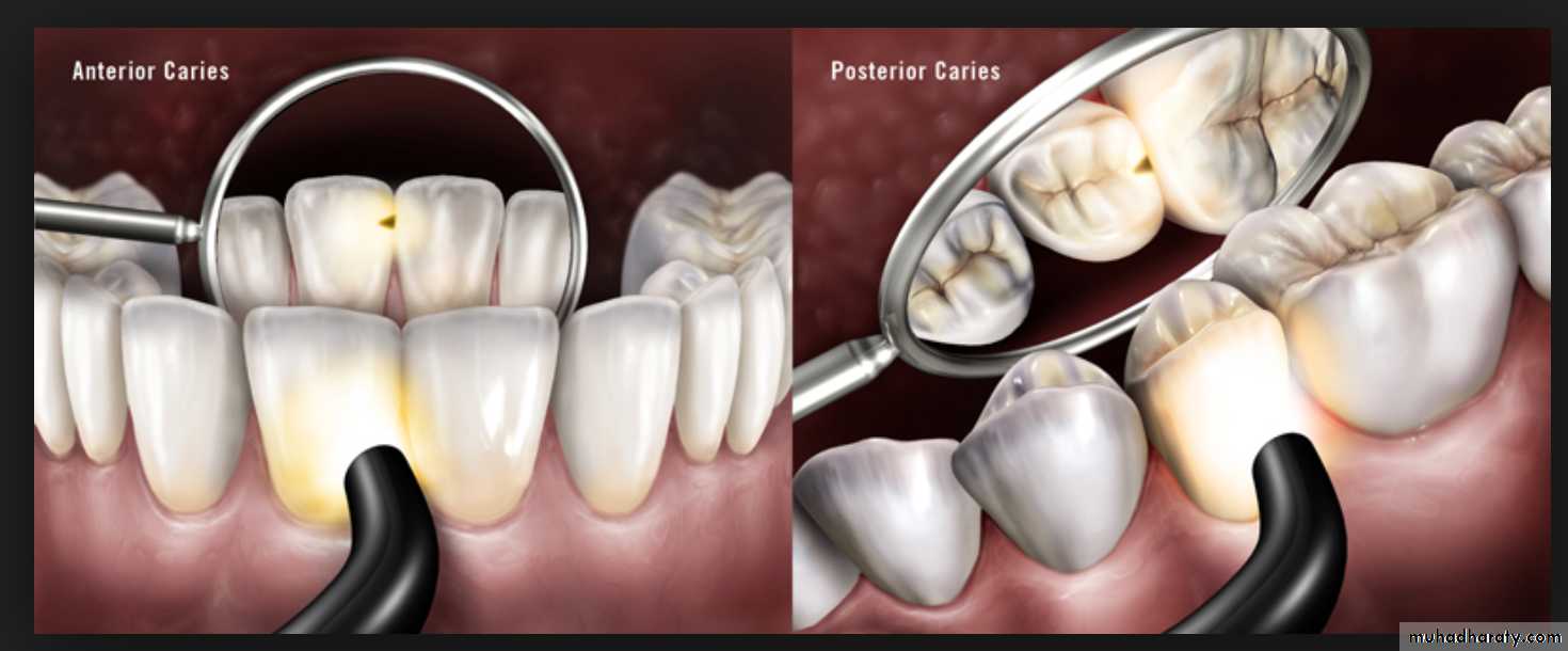 Diagnosis of caries
