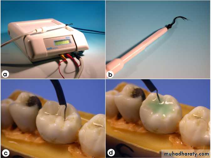 Diagnosis of caries