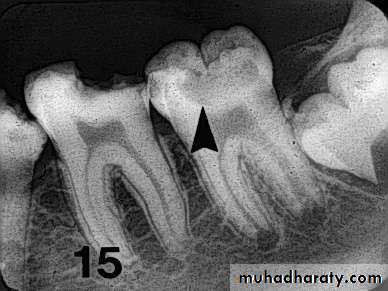 Diagnosis of caries