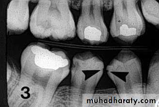 Diagnosis of caries