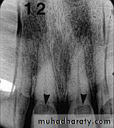 Diagnosis of caries