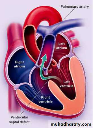 Heart disease