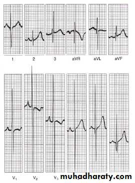 Heart disease