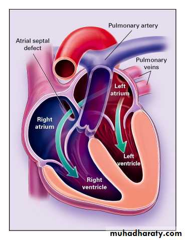 Heart disease