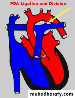 Heart disease