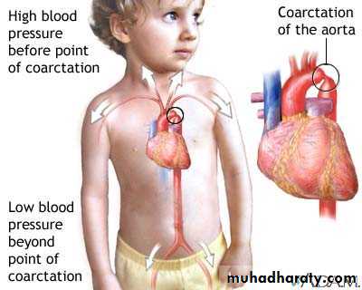 Heart disease
