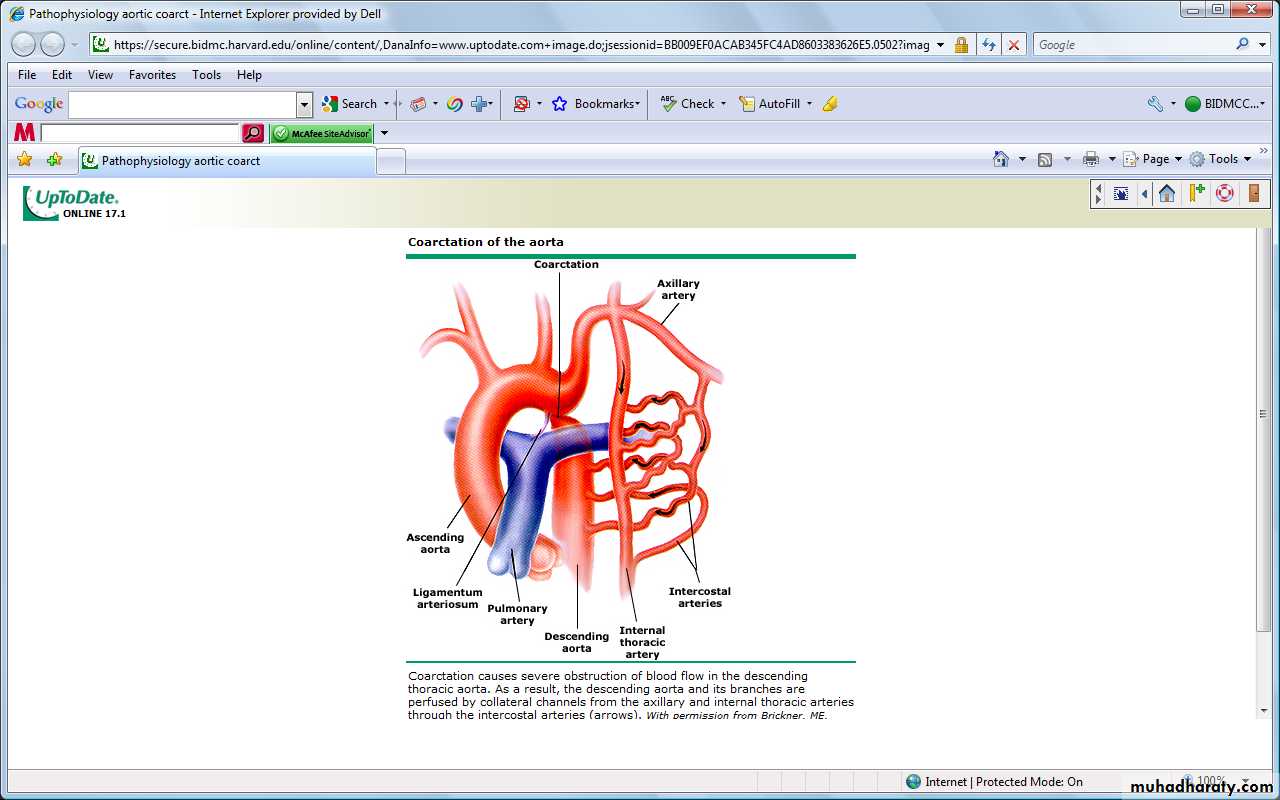 Heart disease
