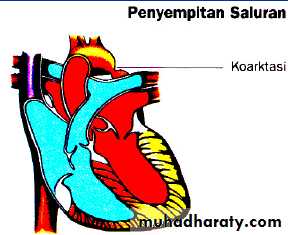 Heart disease