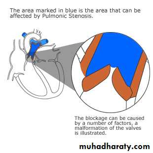 Heart disease