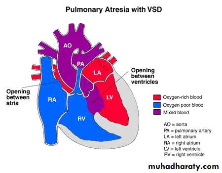 Heart disease