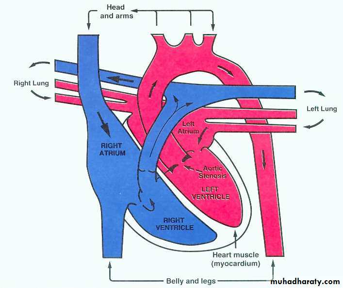 Heart disease