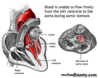 Heart disease