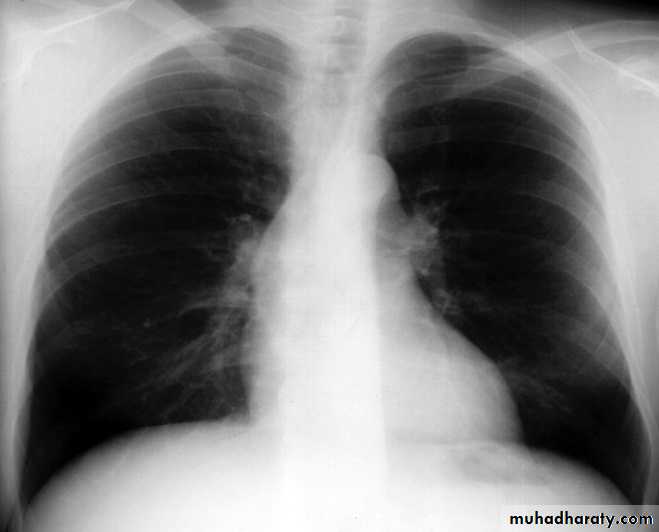 Heart disease