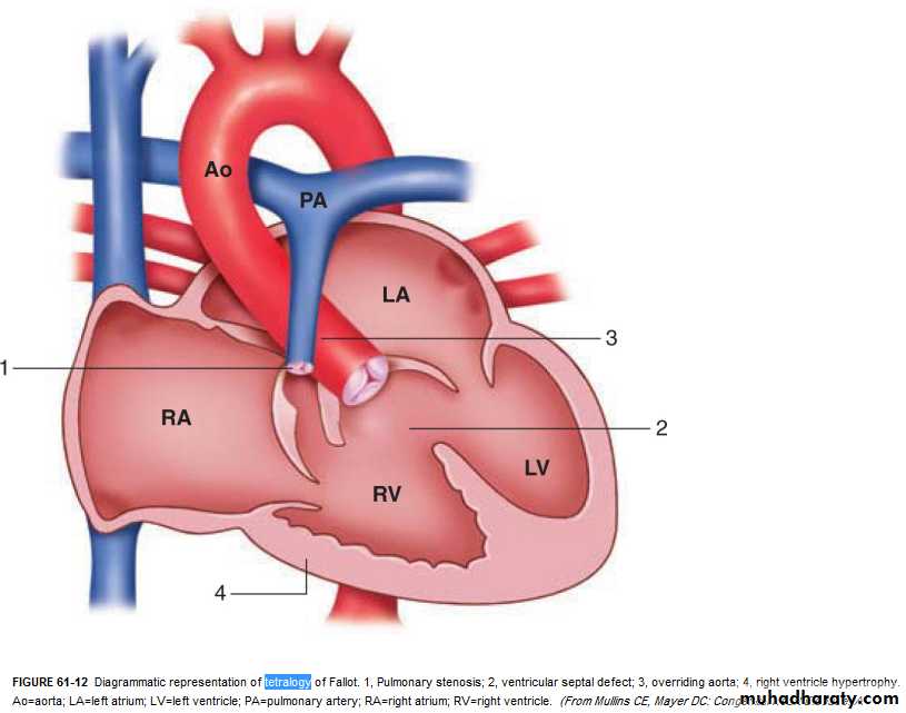 Heart disease
