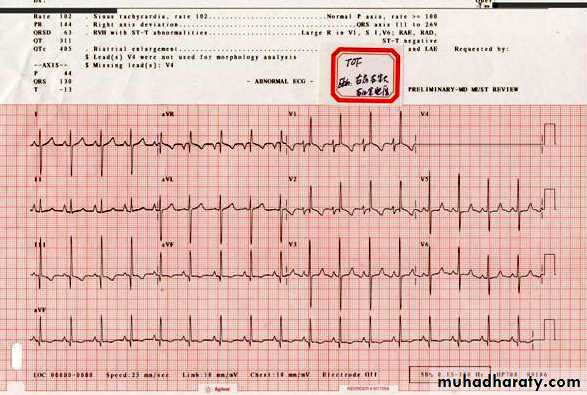Heart disease