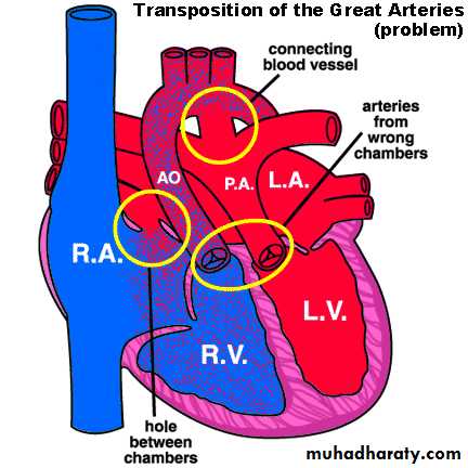 Heart disease