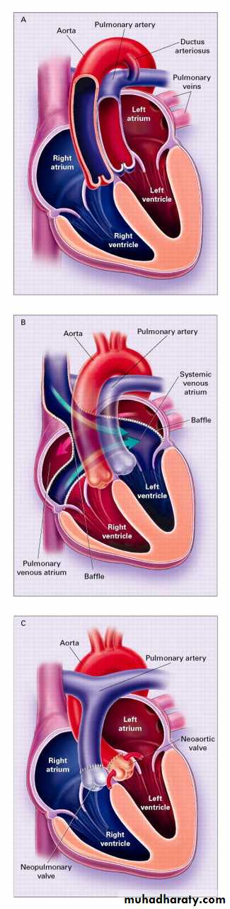 Heart disease