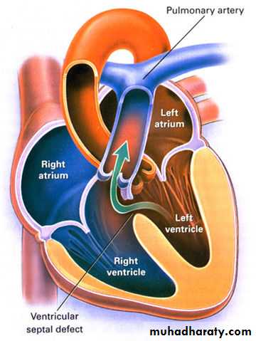 Heart disease