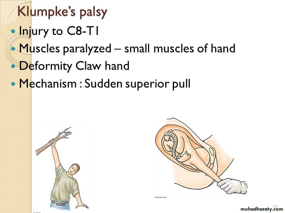 brachial pl