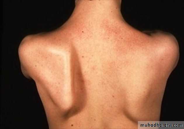 brachial pl