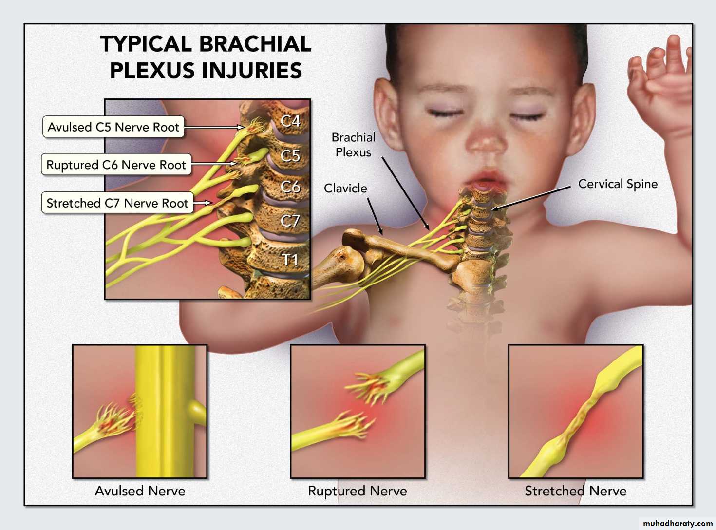 brachial pl