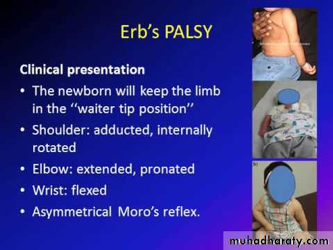 brachial pl