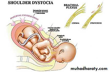 brachial pl