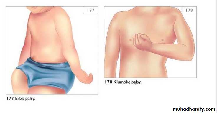 brachial pl