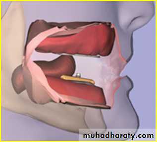 Jaw relationship II