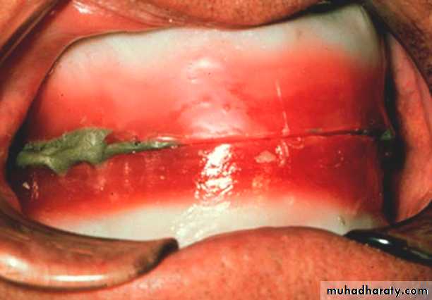 Jaw relationship II