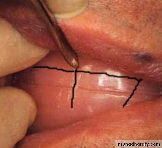 Jaw relationship II