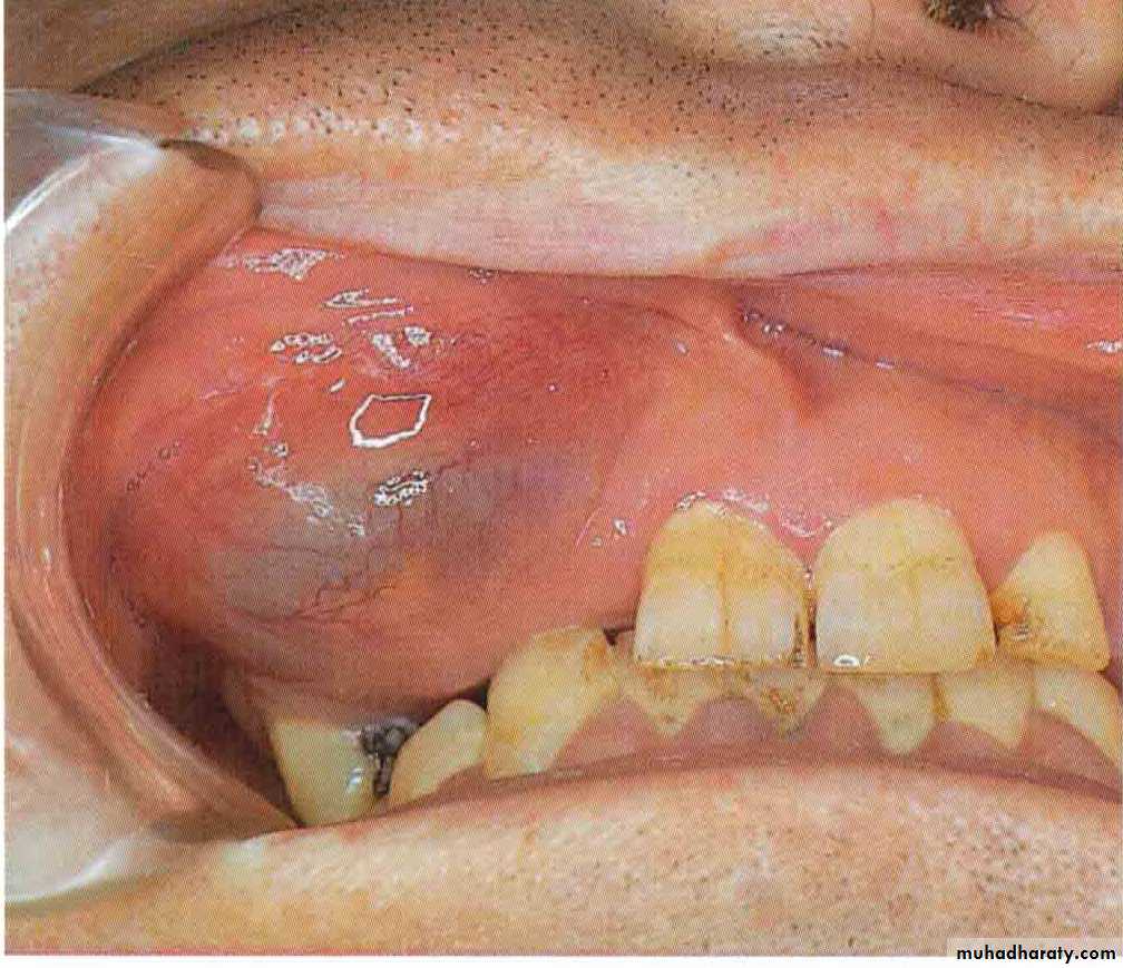 Cyst
