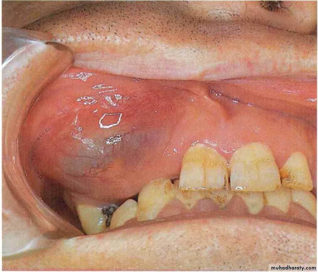Cyst