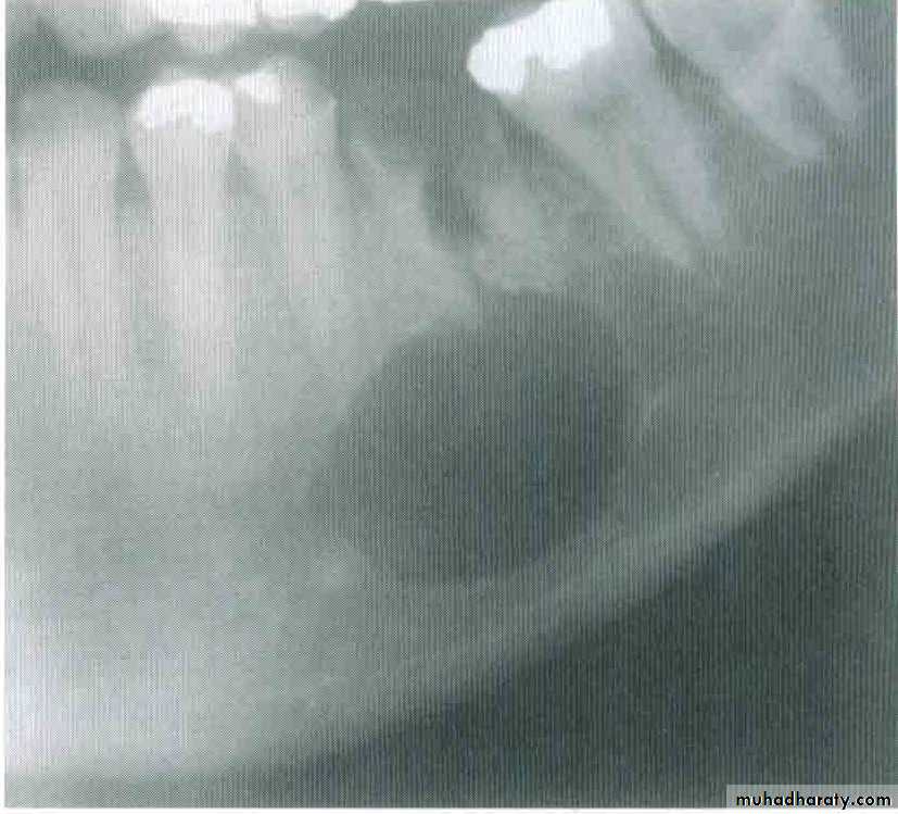 Cyst