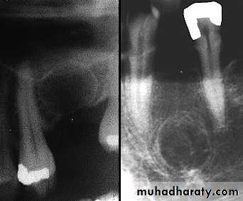 Cyst